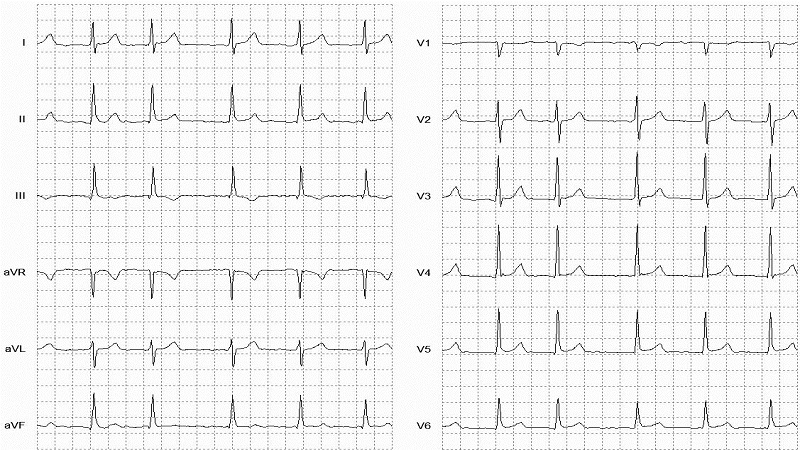 Atrial Fibrillation 12 Lead EKG_fig3